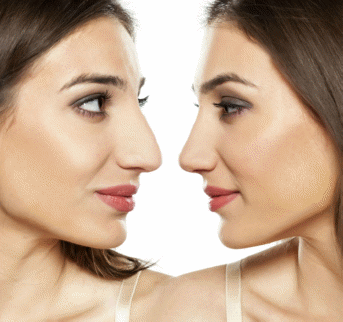 rhinoplastie